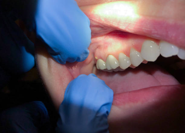 Best Emergency Dental Care for Broken or Chipped Teeth in Hermann, MO
